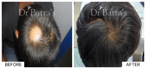 Hair Falling Treatment